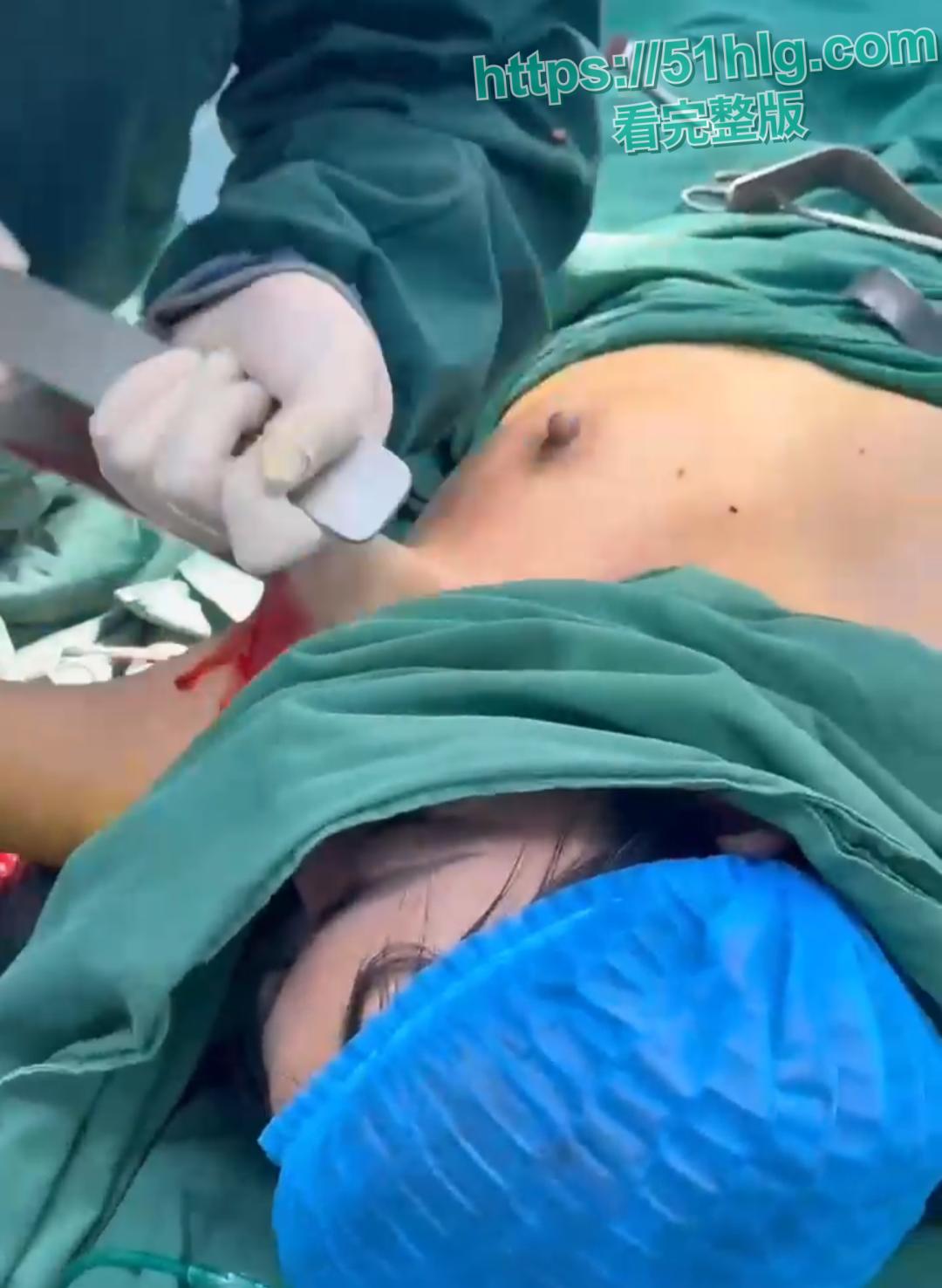 隆胸整形手术现场震惊你的眼球!平乳妹秒变巨乳御姐,女人为变美, 对自己真的太狠了-1