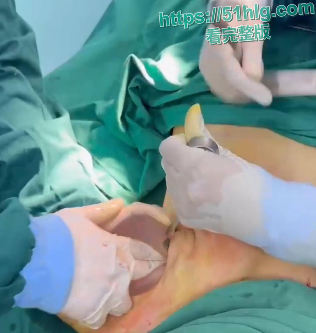 隆胸整形手术现场震惊你的眼球!平乳妹秒变巨乳御姐,女人为变美, 对自己真的太狠了-4