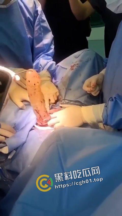活久见！超大假阳具塞进体内拿不出来只能做手术 你们男同玩的都这么狠吗-3