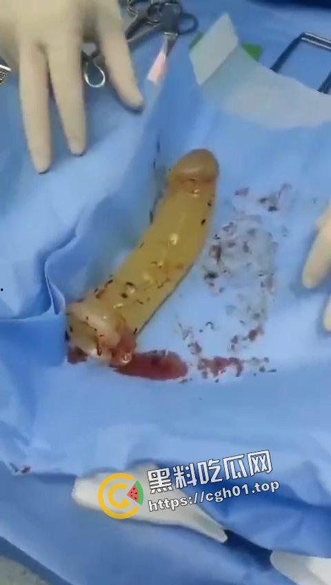 活久见！超大假阳具塞进体内拿不出来只能做手术 你们男同玩的都这么狠吗-4