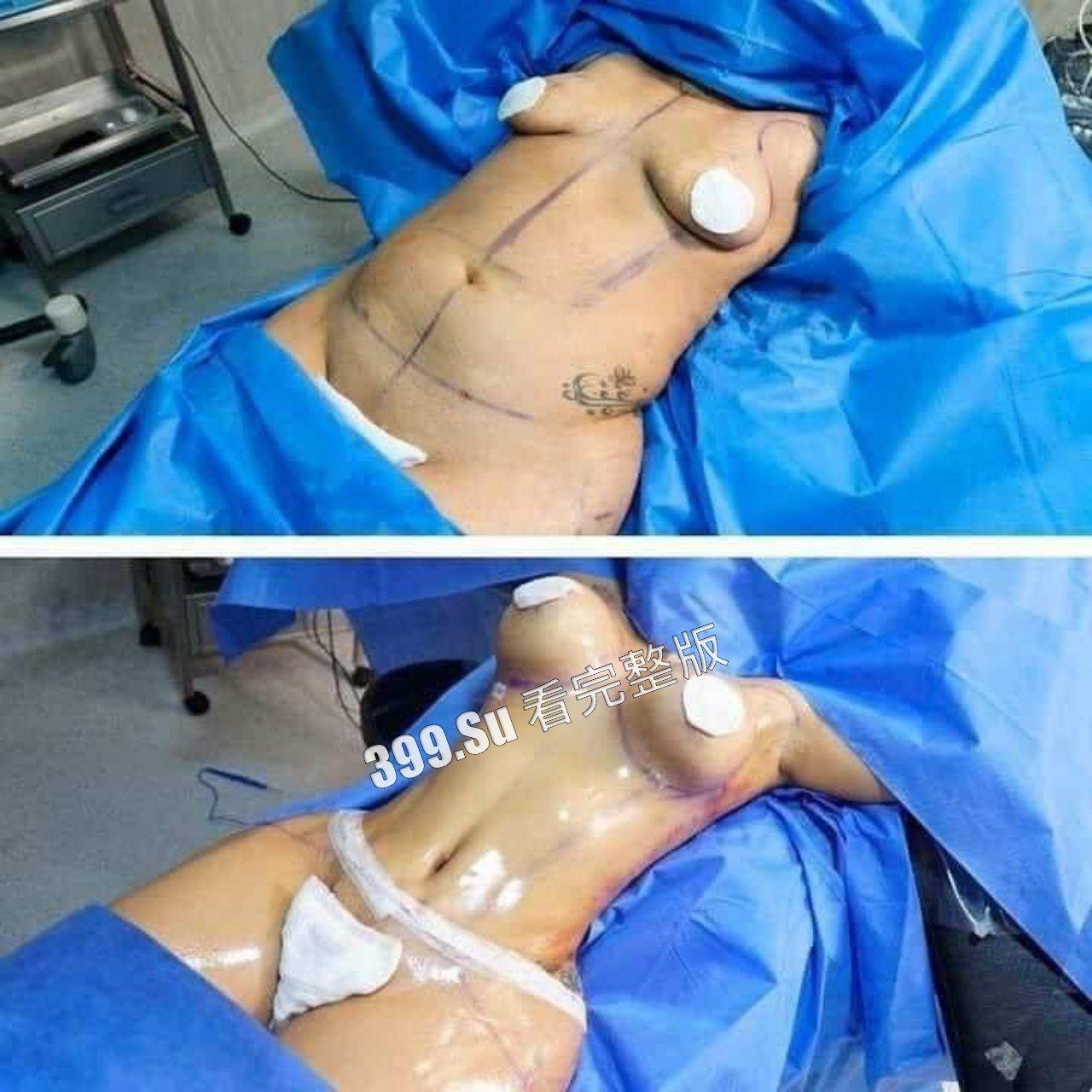 医美整形那些事儿 假的真不了  女人对自己真狠 阴唇黑了就直接切掉 （二）-1