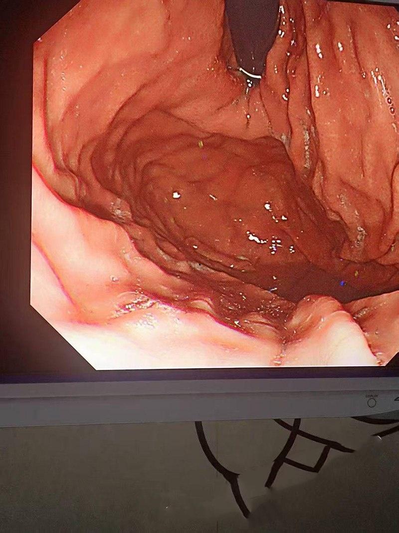 真刺激!男模激情拳交玩过火,结果金戒指卡屁眼里,深夜紧急送医取出,医生直叹牛逼-6