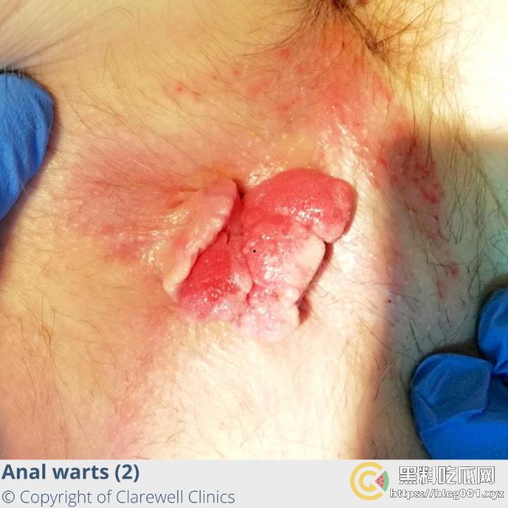 性病篇  谨慎观看！瓜友们出门在外 一定得洁身自爱 世界上没有后悔药  安全第一！！！ （二）-3