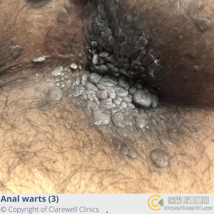 性病篇  谨慎观看！瓜友们出门在外 一定得洁身自爱 世界上没有后悔药  安全第一！！！ （二）-4