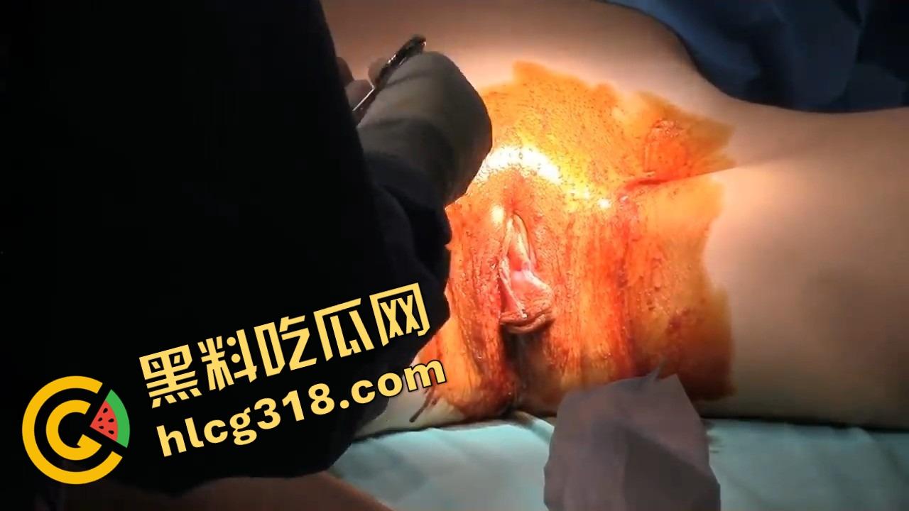 阴唇整形一刀逆天改命，黑木耳变粉鲍鱼，大阴唇手术直接打造一线天馒头逼，姑娘做完直接彩礼翻倍！-6