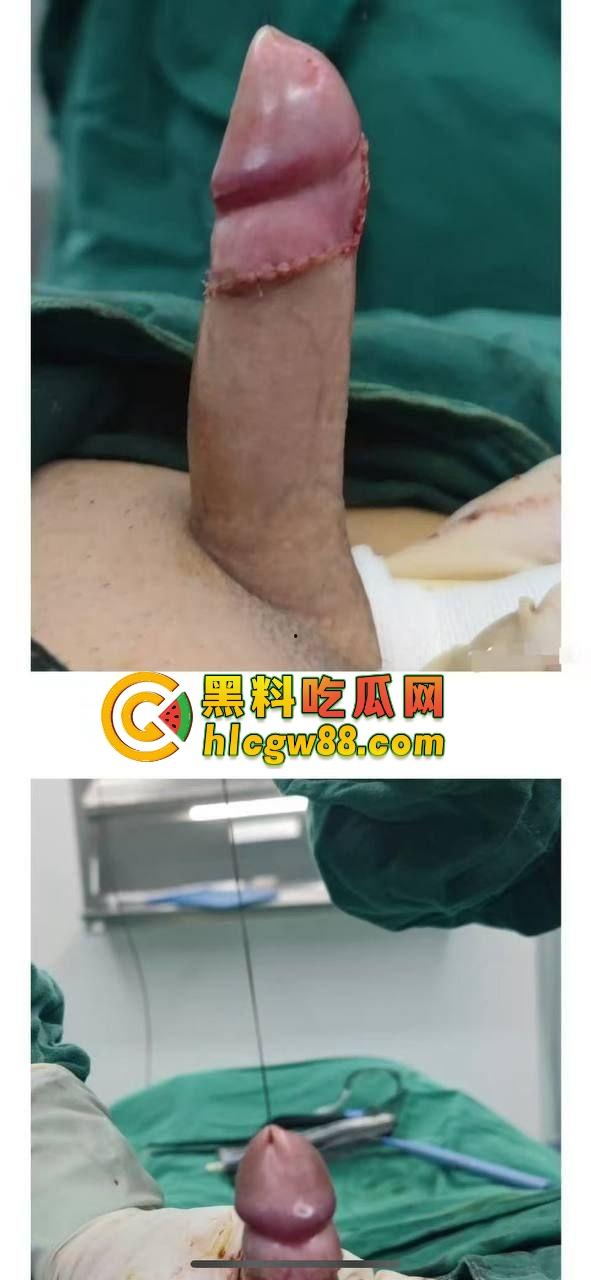 小鸟变大雕换炮计划！阴茎增大手术震撼实测 9CM秒变18CM战神之枪 ，这根真的压不住了！-2