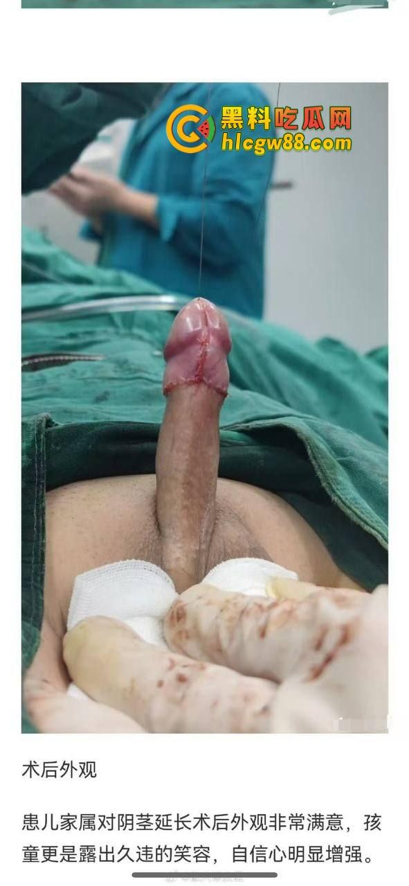 小鸟变大雕换炮计划！阴茎增大手术震撼实测 9CM秒变18CM战神之枪 ，这根真的压不住了！-3