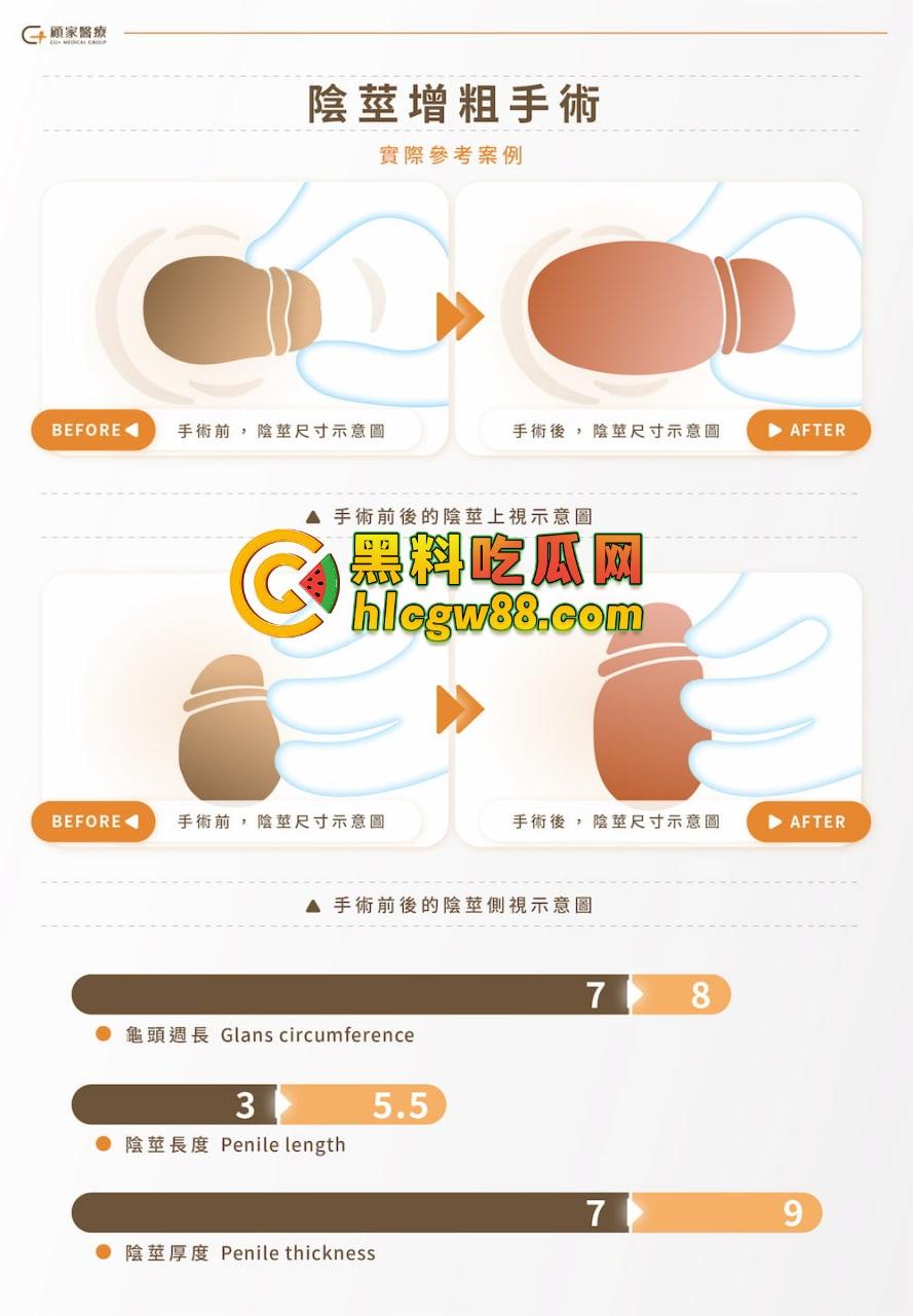 小鸟变大雕换炮计划！阴茎增大手术震撼实测 9CM秒变18CM战神之枪 ，这根真的压不住了！-5